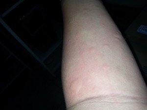 Chronic Urticaria